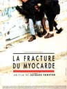 La Fracture du Myocarde