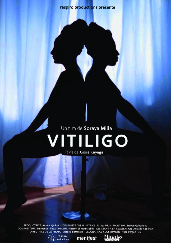Vitiligo Vitiligo